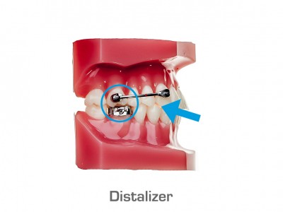 Distalizer (bovenkaak) | 1. De Distalizer is in zijn geheel losgelaten. Bellen voor een afspraak tijdens reguliere praktijkuren en de Distalizer meenemen. 2. De Distalizer is links/rechts aan voor- of achterzijde los. Probeer de Distalizer in zijn geheel te verwijderen. Bellen voor een afspraak tijdens reguliere praktijkuren en de Distalizer meenemen. 3. De slotjes in de onderkaak waaraan de elastieken bevestigd moeten worden hebben losgelaten. Elastieken niet dragen, bellen voor een afspraak tijdens reguliere praktijkuren.