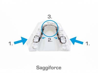 Saggiforce (Onder- en bovenkaak) | 1. Links/rechts heeft de band om de kies losgelaten. U kunt proberen deze terug te drukken, lukt dit niet: het noodnummer bellen. 2. Links of rechts heeft het stangetje losgelaten. U kunt proberen de stang weer in het slot te duwen of de stang aan de andere kant ook los te maken. Hiervoor moet u in de meeste gevallen een elastiekje verwijderen. 3. Het stangetje veroorzaakt een ontsteking in de mondbodem. Hiervoor kunt u het noodnummer bellen.