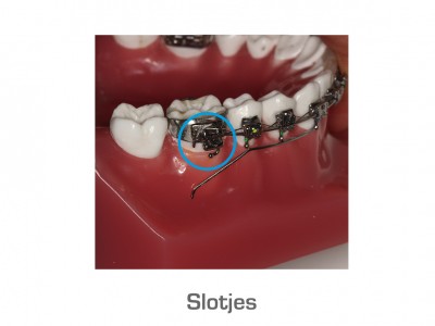 Slotjes (boven- en onderkaak) | 1. Wanneer er een slotje heeft losgelaten hoeft u hiervoor alleen maar te bellen als er sprake is van ernstig pijn. Is dit niet het geval, tijdens de reguliere openingstijden contact opnemen. 2. Er is geen sprake van pijn, maar het slotje stoort wel: proberen af te plakken met wax.